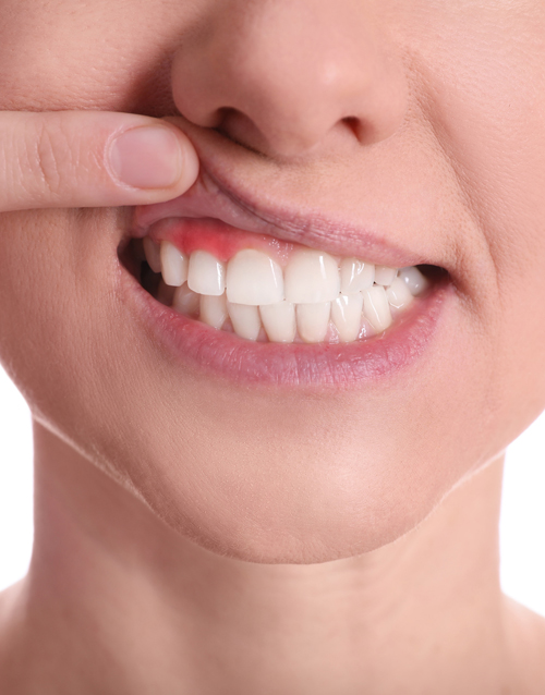 An extreme close-up of a dental patient having their teeth cleaned by the hygieniest.
